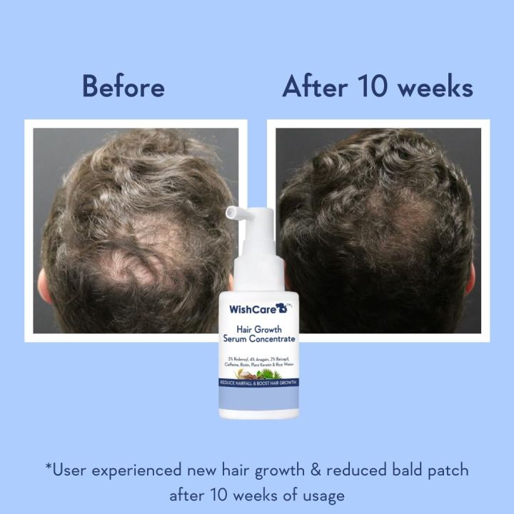 Wishcare%20Hair%20Growth%20Serum%20Concentrate%20-%20Redensyl,%20Anagain,%20Caffeine,%20Biotin,%20Keratin%20&%20Rice%20Water%2030ml%20-%20Image%202