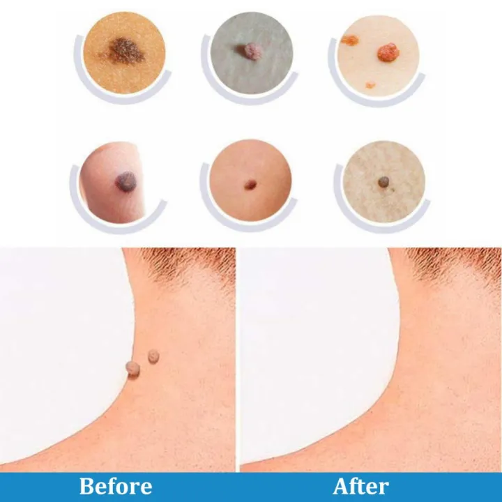 Huangdian%20Profesional%202In1%20Painless%20Auto%20Skin%20Tag%20Mole%20Wart%20Removal%20Kit%20Face%20Skin%20Care%20Body%20Wart%20And%20Dot%20Treatments%20Remover%20Plantar%20Warts%20Corn%20Removal%20-%20Image%206