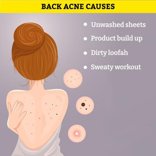 Chemist%20At%20Play%20Acne%20Control%20Body%20Wash%20236ml%20-%20Image%203