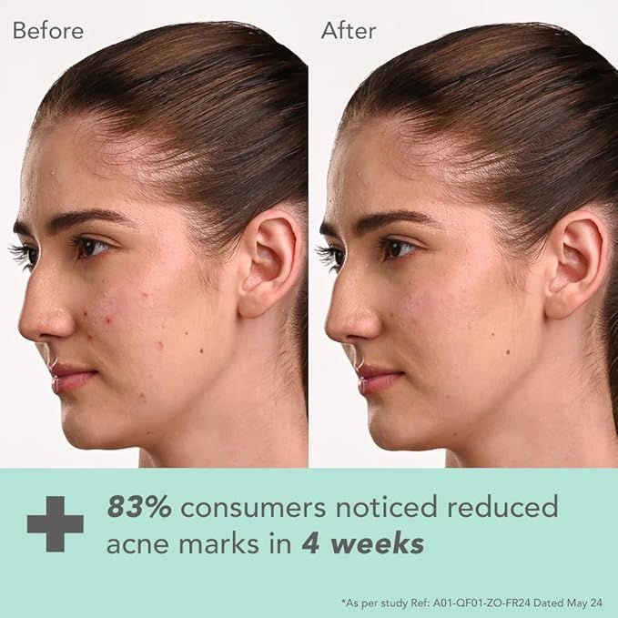 Lotus%20DermaBotanics%20Kojic%20Acid%20+%20Multi%20Berry%20Hi-Dose%20Serum%20%7C%20Reduces%20Pigmentation%20&%20Dark%20Spots%20%7C%20Calms%20Redness%20%7C%20Made%20with%20Dermatologists%20%7C%20Non-irritating%20%7C%20pH%205.5%20%7C%20Suitable%20for%20Sensitive%20Skin%20%7C%2028ml%20-%20Image%205