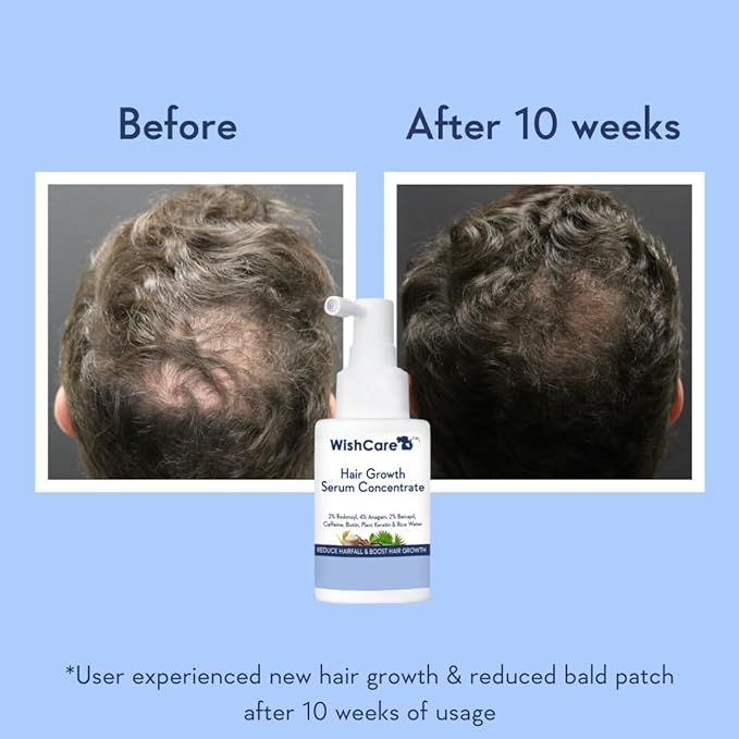 WishCare%20Hair%20Growth%20Serum%20%7C%20Reduces%20Hair%20Fall%20%7C%20Boosts%20Hair%20Growth%20%7C%2030%20ml%20-%20Image%202