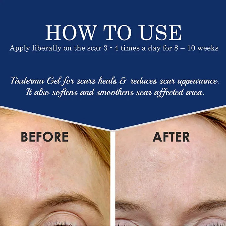 Scar%20Gel%20Fix%20Derma,%20Scar%20Removal%20Gel,%20For%20All%20Age%20Group,%2015Ml%20-%20Image%204