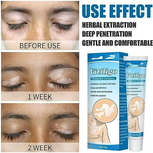 NUTRIG%20Vitiligo%20Treatment%20Cream%20for%20White%20Spots,%20Vitiligo%20Cream%20Treatment%20Ointment%20Leucoplia%20Relief%20Repair%20Melanin/20g%20-%20Image%205