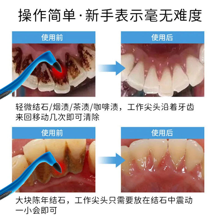 Shunamei%20Portable%20Tooth%20Stain%20Removal%20Tartar%20Cleaning%20Stick%20with%20Handle%20Tartar%20Remover%20Tooth%20Stain%20Cleaner%20-%20Image%203