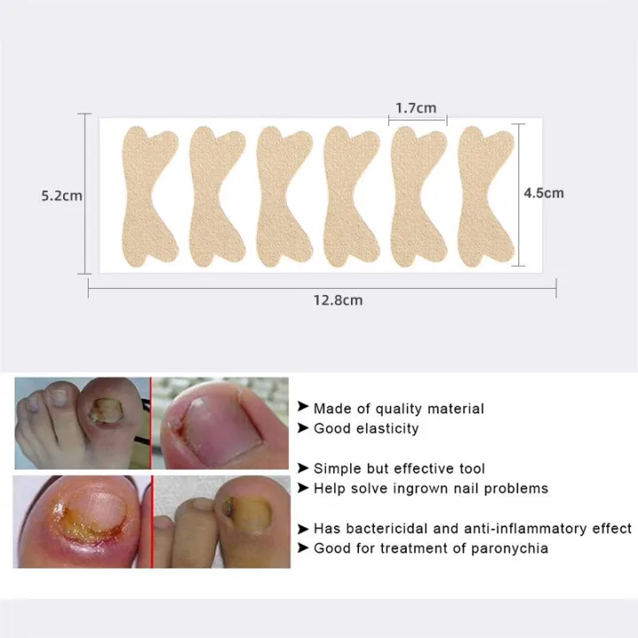 HOT%20Pexmen%206Pcs/Sheet%20Ingrown%20Toenail%20Correction%20Sticker%20Adhesive%20Toenail%20Patch%20Toe%20Nail%20Treatment%20Corrector%20Foot%20Care%20Tool%20-%20Image%203