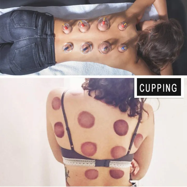 12%20Cups%20Professional%20Acupoint%20Cupping%20Set%20Acupuncture%20Cupping%20Therapy%20Kit%20Cellulite%20Massage%20Kit%20-%20Image%207