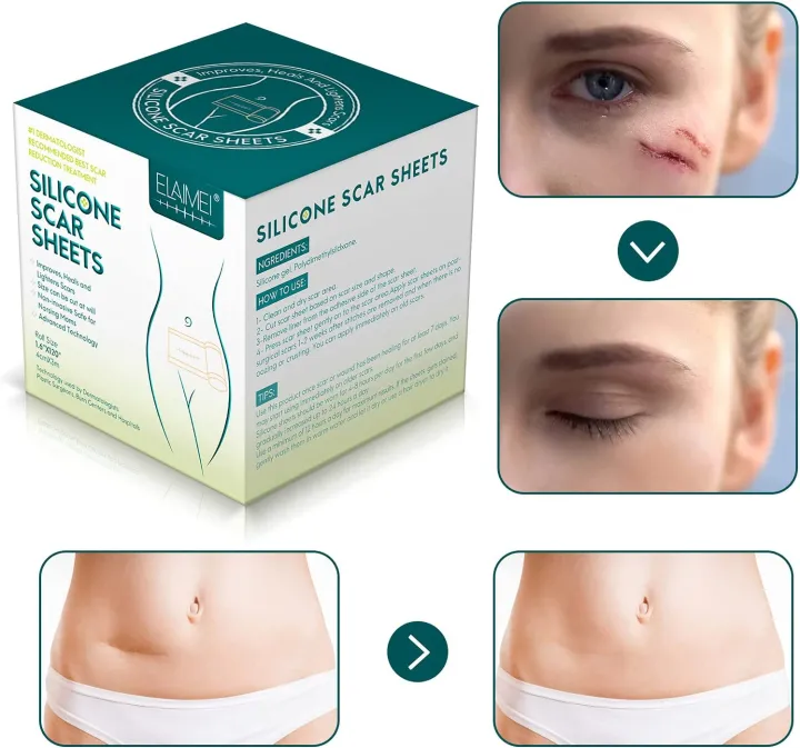 New%20model%201.5M/3M%20Scar%20Removal%20Patch%20Surgery%20Self-Adhesive%20Silicone%20Gel%20Tape%20Remove%20Scar%20Patch%20Sticker%20Acne%20Trauma%20Burn%20Scar%20Skin%20Care%20-%20Image%208
