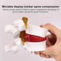 High Quality 3D Model Lumbar Model Compression Demonstration .5X Enlarge Human Anatomy Skeleton Model Spinal Pressure Lesions Simulation Lumbar Disc Herniation Teaching Tool Nursing. 