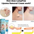 South Moon LumpFree Lipoma Removal Cream And Moisturizers-20g. 