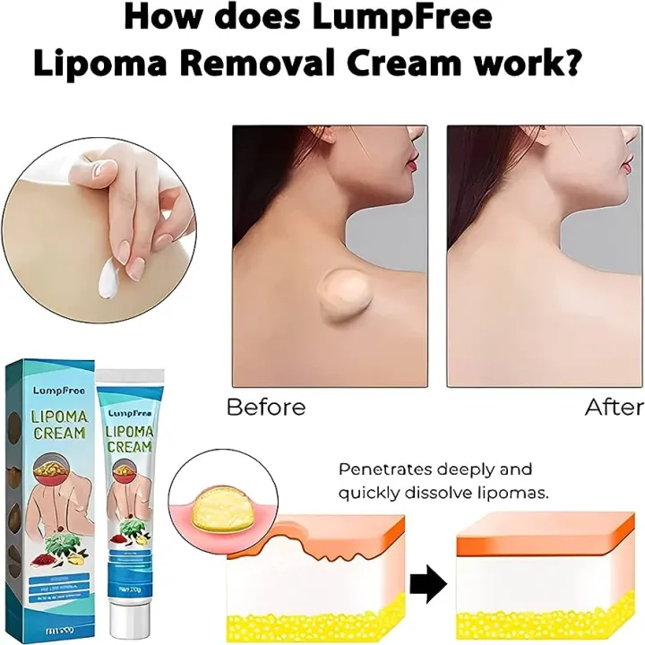 South%20Moon%20LumpFree%20Lipoma%20Removal%20Cream%20And%20Moisturizers-20g%20-%20Image%202
