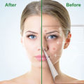 Pimple Remover Patch Stickers – Acne Treatment, 30 Pcs (1 Tab). 