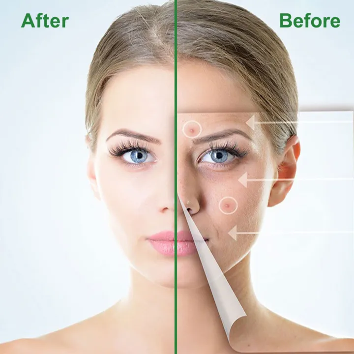 Pimple%20Remover%20Patch%20Stickers%20%E2%80%93%20Acne%20Treatment,%2030%20Pcs%20(1%20Tab)%20-%20Image%203
