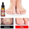Ingrown Toenail Treatment Drop - Ingrown Toenail Treatment - Cuticle Care Oils for Ingrown Toenails - Trimming Toenail Softening Drops Fungal Nail Treatment. 