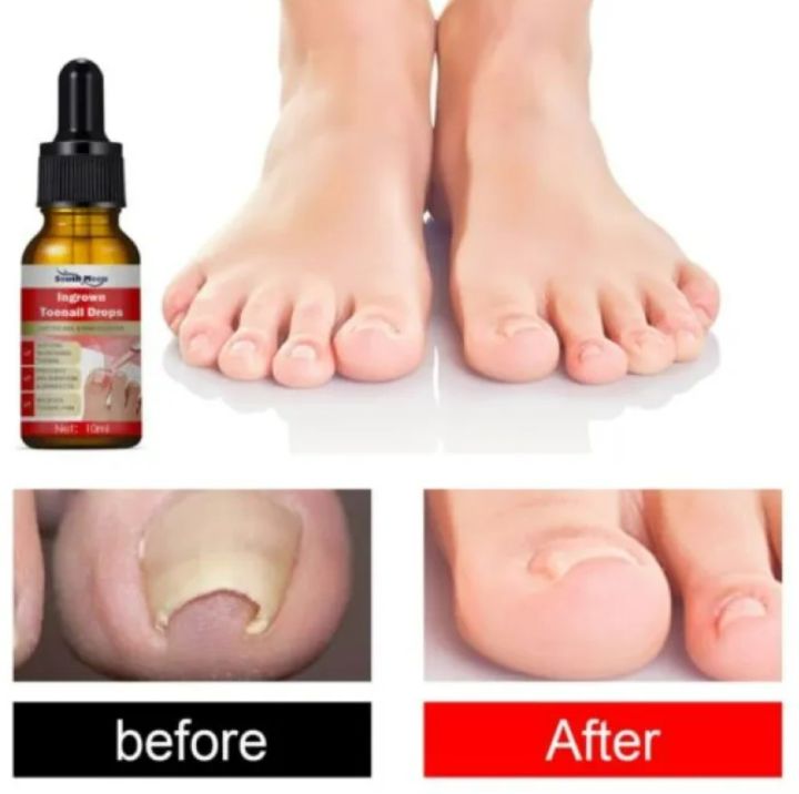 Ingrown%20Toenail%20Treatment%20Drop%20-%20Ingrown%20Toenail%20Treatment%20-%20Cuticle%20Care%20Oils%20for%20Ingrown%20Toenails%20-%20Trimming%20Toenail%20Softening%20Drops%20Fungal%20Nail%20Treatment%20-%20Image%202