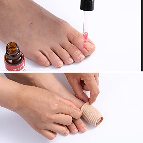 Ingrown%20Toenail%20Pain%20Relief%20Drops%20-%2030ml%20-%20Image%203