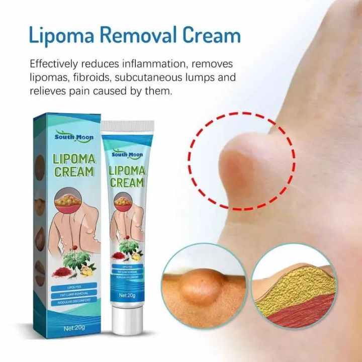 4pcs Lipoma Removal Cream – Herbal Natural Fat Lump Treatment | Sebaceous Cyst, Fibroma, Skin Lump, Fatty Tumor, Muscle Knot Removal Ointment – 20g