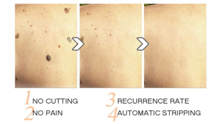 Aichun%20Beauty%20Wart%20Remover%20Cream%20Anti-Wart%20Cream%20Wart%20Treatment%20Skin%20Tags%20&%20Light%20Moles%20Removal%20-20g%20-%20Image%205