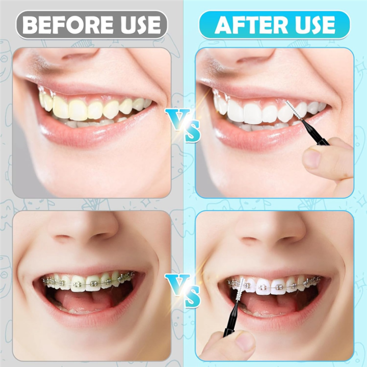 Nullmul%20120pcs%20Interdental%20Brushes,%20Braces%20Brush%20Cleaner%20for%20Teeth%20Cleaning%20Tools%20Spiral%20Dental%20Brush%20for%20Efficient%20Oral%20Care%20A%20-%20Image%207