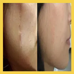 Scar%20Removal%20Cream%20-%20TCM%20Scar%20Cream%20for%20Surgical%20Scars,%20Acne%20Skin%20Care%20Cream,%20Acne%20Treatment%20Cream%20for%20Scars,%20Burns,%20Stretch%20Marks,%20Acne%20Spots%20-%20Image%205