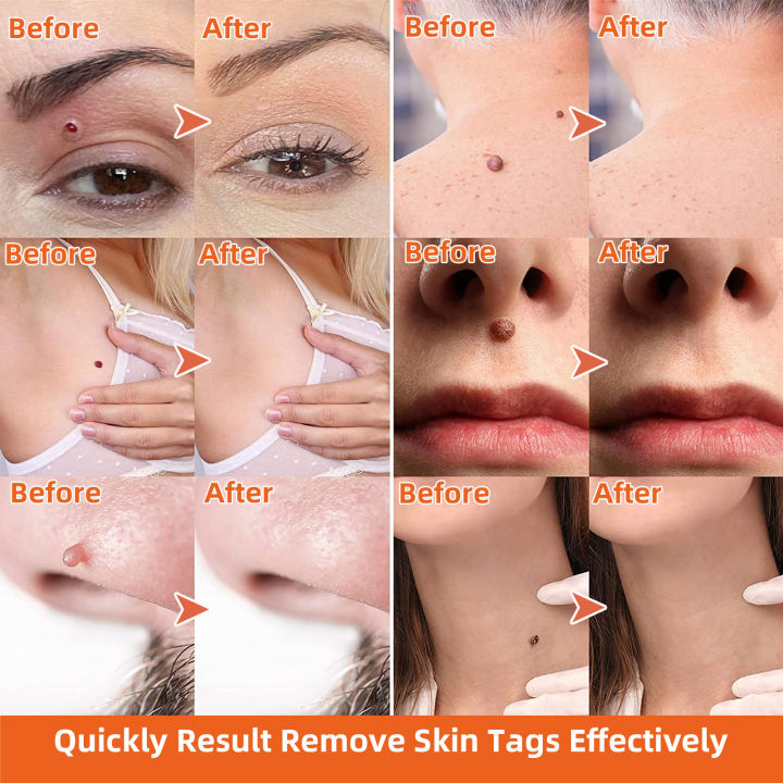 Painless%20Safe%20Skin%20Tag%20Remove%20Device%20Kit%20Micro%20Tags%20Sized(2mm%20to%204mm)%20Warts%20Remover%20Original%20Skin%20Band%20Tool%20Set%20-%20Image%205