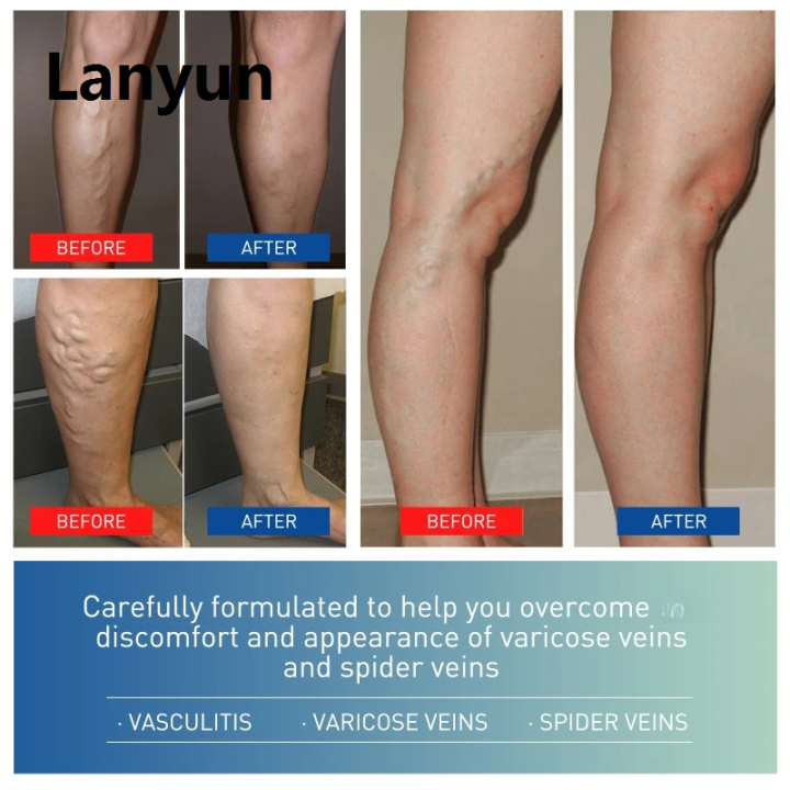 Lanyun%2020g%20Varicose%20Vein%20Relief%20Cream%20Tongmai%20Effective%20Relieves%20Leg%20Bulge%20Portable%20Pain%20Plant%20Extracts%20Treatment%20and%20Repair%20Cream%20Skin%20Care%20-%20Image%203
