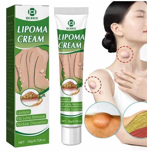 Ouhoe%20Instant%20Lipoma%20Removal%20Cream%20Lipolysis%20Fat%20Lump%20Relief%20Plaster%20Anti%20Swelling%20And%20Moisturizers-20gram%20-%20Image%205