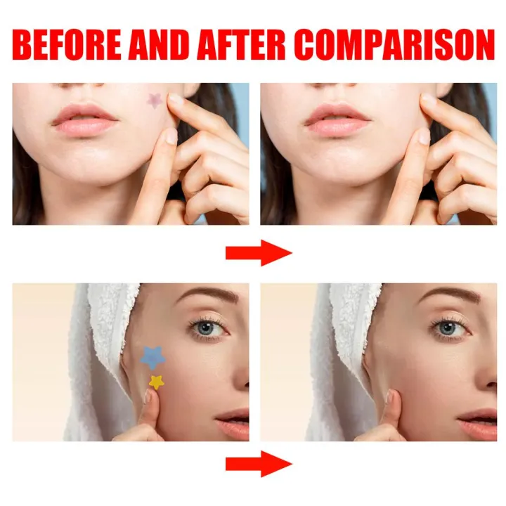 New%20200pcs%20Star%20Pimple%20Patch%20Acne%20Colorful%20Invisible%20Acne%20Removal%20Skin%20Care%20Stickers%20Face%20Spot%20Beauty%20Makeup%20Tool%20-%20Image%205