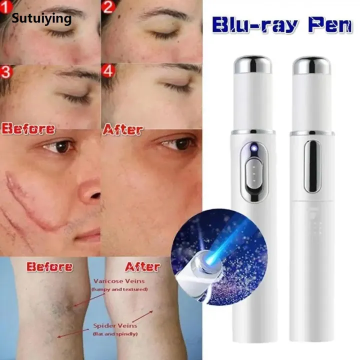 Sutuiying%20Blue%20Light%20Therapy%20Acne%20Laser%20Pen%20LED%20Face%20Light%20Therapy%20For%20Scar%20Original%20Wrinkle%20Removal%20Treatment%20Device%20Skin%20Care%20Beauty%20Equipment%20-%20Image%203