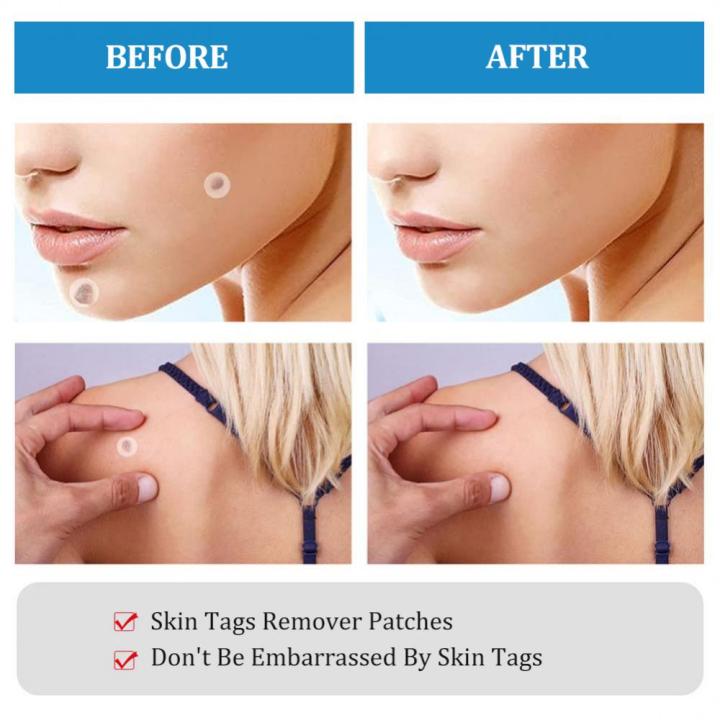 Huangdian Profesional 2In1 Painless Auto Skin Tag Mole Wart Removal Kit Face Skin Care Body Wart And Dot Treatments Remover Plantar Warts Corn Removal