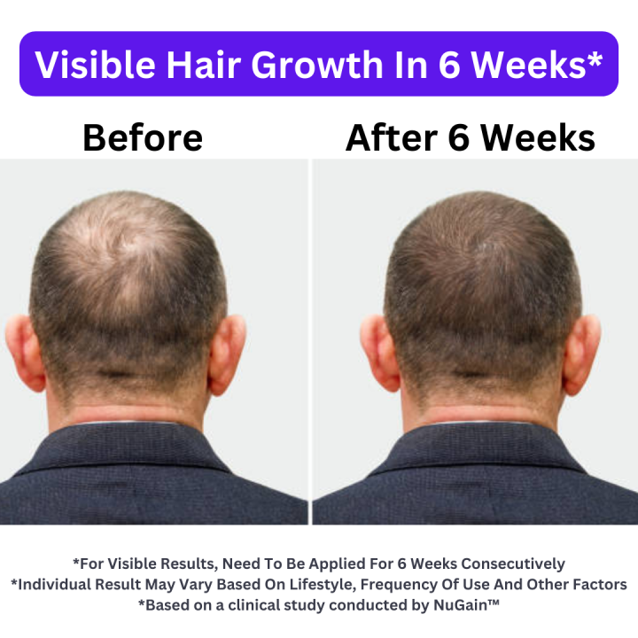 Oreva%20Nugain%20Hair%20Growth%20Serum%20100ml%20%7C%20Anti%20Hairfall%20Serum%20Stimulates%20Hair%20Growth%20%7C%20Reduce%20Breakage%20And%20Hair%20Fall%20-%20Image%203