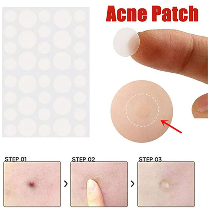 36Pcs%20Skin%20Tag%20&%20Acne%20Patch%20Hydrocolloid%20Acne%20and%20Skin%20Tag%20Remover%20Patches%20-%20Image%206