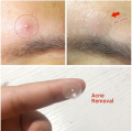 Pimple Remover Patch Stickers – Acne Treatment, 30 Pcs (1 Tab). 