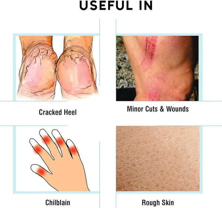 Cutfar%20Ointment%202pcs%20Set%20For%20Cracked%20Heels%20Rough%20Skin%20Chilblain%20And%20Cuts%20Wounds%20-%20Image%203