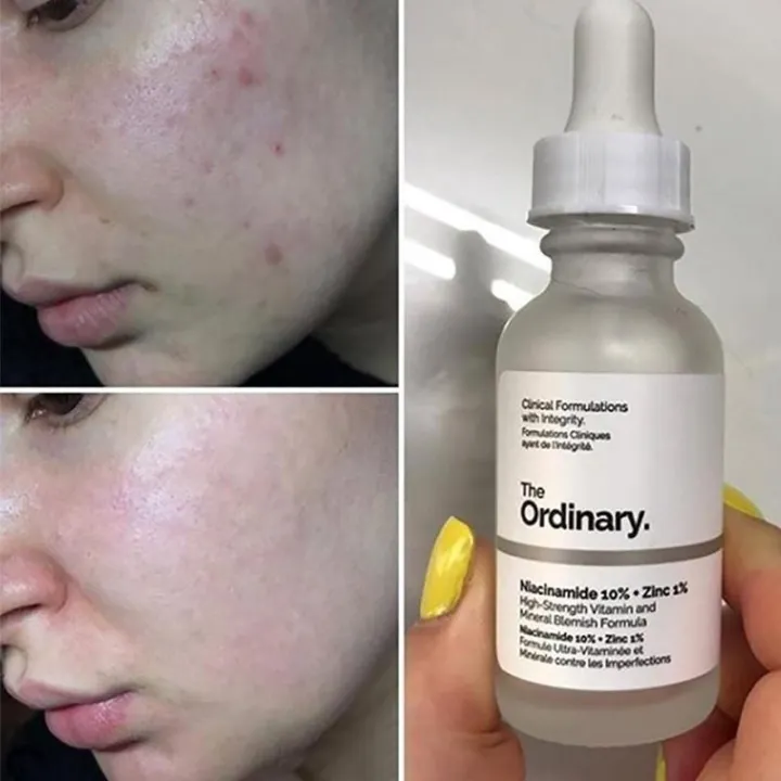 The%20Ordinary%20Niacinamide%2010%25%20+%20Zinc%201%25%20Serum%20(30ml)%20-%20Image%208