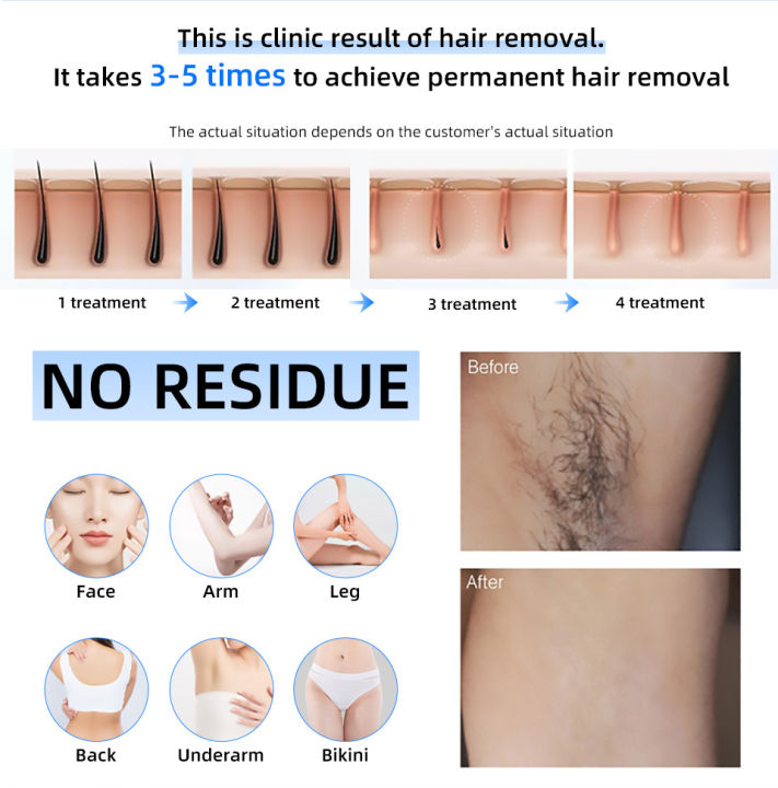 New%20goods%20tideLaser%20Home%20Appliance%20Spa%20Rate%20Depi%20New%20Launch%20High%20Power%20Ladora%20Laser%20Permanent%20Diode%20Laser%20Hair%20Removal%20Machine%20Professional%20808NM%20Painless%20-%20Image%205