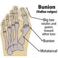 1 Pair Super Elastic Bunion Sleeve Bunion Corrector Protector PreventHallux Valgus - Foot Caring Toe Corrector. 
