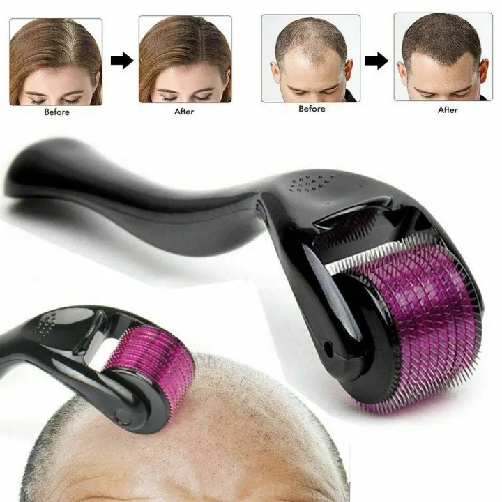 1mm%20540%20Micro%20Needle%20Derma%20Roller%20Therapy%20Skin%20-%20Image%203