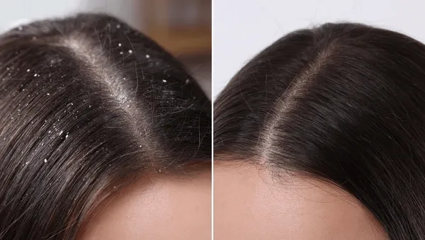2pcs%20Oreva%20Derma%20Care%20Ketoconazole%202%25%20Anti%20Dandruff%20OnOn%20Shampoo%20100ml%20(GET%20FREE%20TAMRICH%20SOAP)%20-%20Image%204