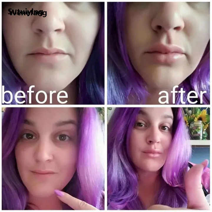 Wenefang%20Sutuiying%20Lip%20Plumper%20Tool%20Lip%20Plumper%20Device%20Fish%20Lips%20Plumper%20New%20style%202025%20Long%20Lasting%20Instant%20Reusable%20Silicone%20Lip%20Plumper%20-%20Image%204