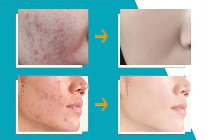 CeraV%D0%B5%20Acne%20Treatment%20&%20Control%20Face%20Cleanser%20237ml%20(USA)%20-%20Image%205