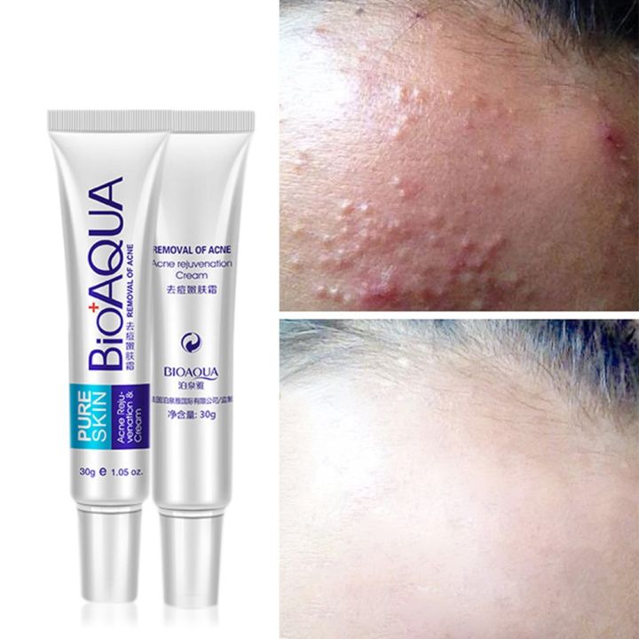 BIOAQUA%20Face%20Skin%20Care%20Acne%20Anti-Wrinkle%20Removal%20Cream%20Spots%20Scar%20Blemish%20Marks%20-%20Image%204