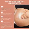 YuanbingLuxury Pregnancy Repair Stretch Mark Removal Acne Scar Maternity Stretch Marks Remove Fat Striae Scars Treatment skin Care. 