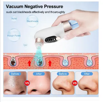 Blackhead%20Remover%20Electric%20Black%20Head%20Remover%20Pore%20Vacuum%20Cleaner%20Micro%20Small%20Bubble%20Acne%20Black%20Head%20Extractor%20Black%20Dot%20Remove%20-%20Image%208
