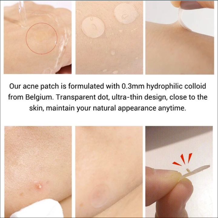 Pimple%20Remover%20Patch%20Stickers%20%E2%80%93%20Acne%20Treatment,%2030%20Pcs%20(1%20Tab)%20-%20Image%204