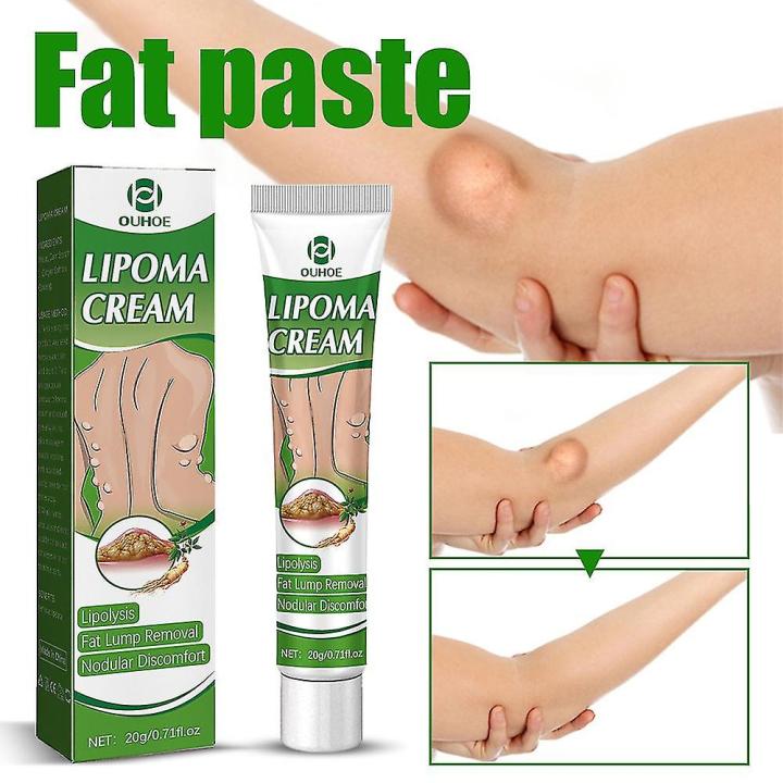 Ouhoe%20Instant%20Lipoma%20Removal%20Cream%20Lipolysis%20Fat%20Lump%20Relief%20Plaster%20Anti%20Swelling%20And%20Moisturizers-20gram%20-%20Image%202