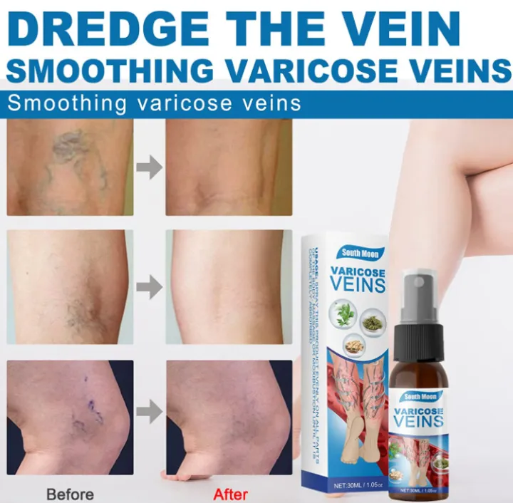 South%20Moon%20Varicose%20Veins%20Spray%20-%2030ml%20-%20Image%202
