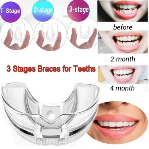 Dental%20Orthodontic%20Teeth%20Corrector%20Braces%20Tooth%20Retainer%20%7C%20Removable%20Teeth%20Straightening%20Trainer%20Tool%20%7C%20Reusable%20Dental%20Alignment%20Corrector%20for%20Oral%20Care,%20Smile%20Support%20&%20Teeth%20Positioning%20(Adults%20&%20Teens)%20-%20Image%203