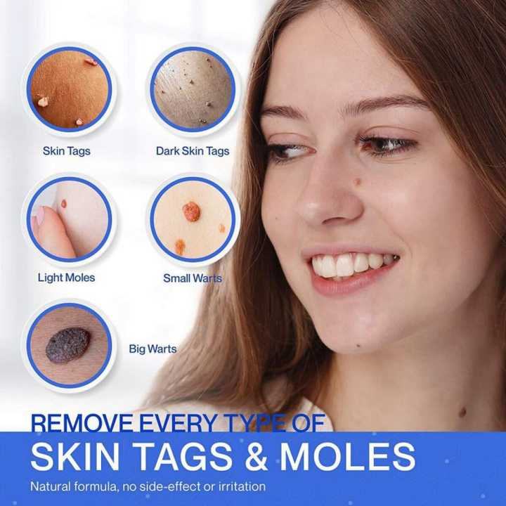 Pack%20Of%204%20Skin%20Tag%20Remover%20Pen%20Natural%20Mole%20Nevus%20Wart%20Skin%20Tag%20-%20Image%202