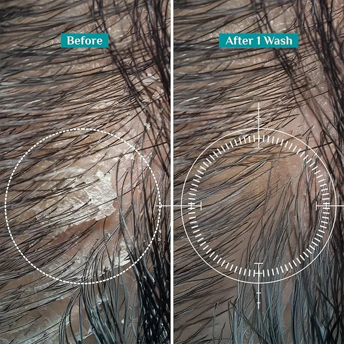 Pilgrim%20Australian%20Tea%20Tree%20Non-Drying%20Anti-Dandruff%20Shampoo%20For%20Prevents%20Dandruff%20Recurrence%20200%20ml%20-%20Image%207