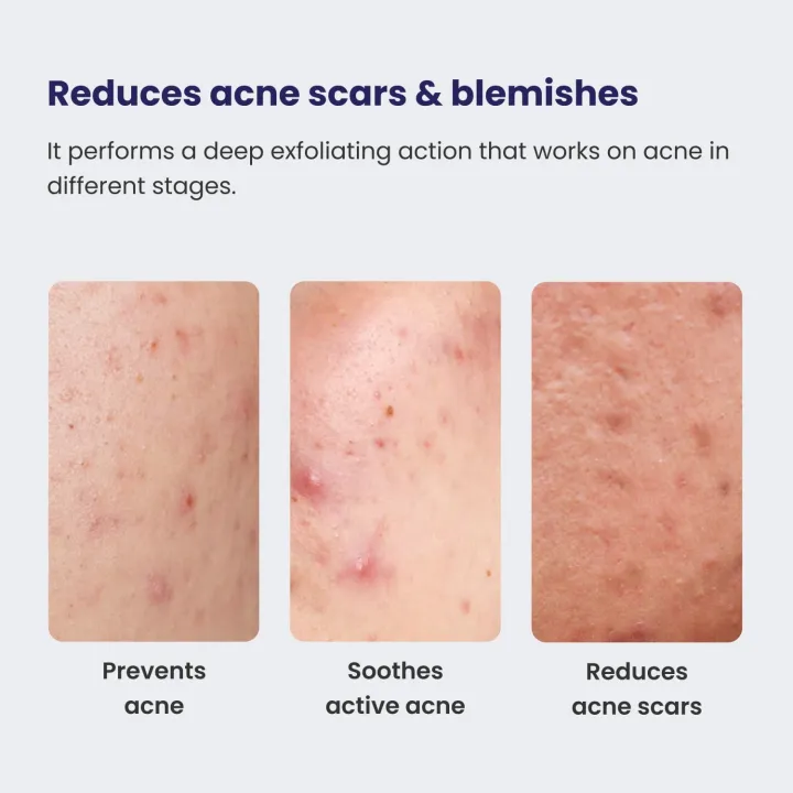 Re'equil%200.5%25%20Retinol%20Night%20Cream%20Makes%20Skin%20Youthful%20&%20Smooth%20Prevents%20Fine%20Lines%20&%20Wrinkles%20Unisex%20All%20Skin%20Types%2030gm%20-%20Image%205